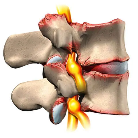 Forminal-stenosis-Pain