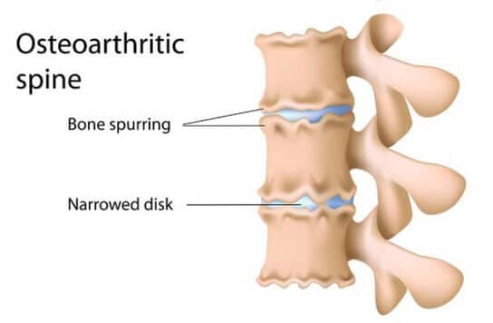 Spinal-Osteoarthritis