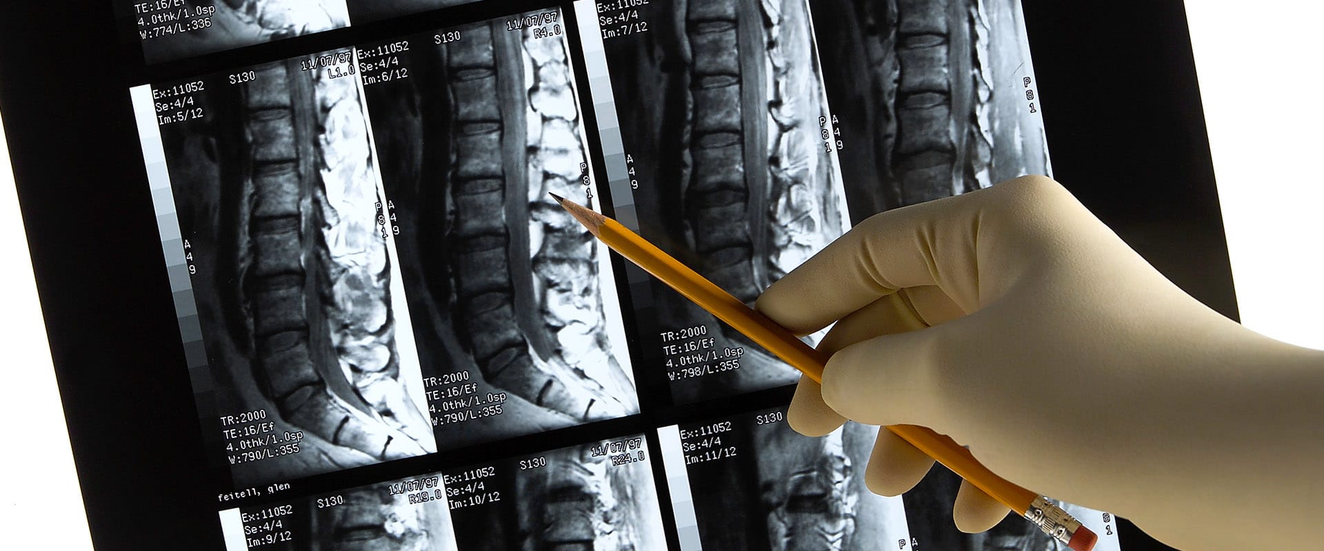 Osteoarthritis Of The Spine