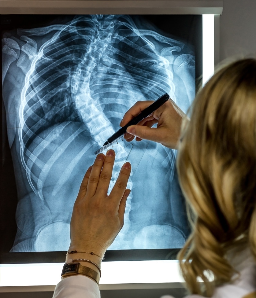 Blonde female physician looking at a patients x-ray. Scoliosis specialist Doctor making measurements at the patients X-Ray
