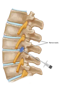 Triangular Nerve Block Patch Nerve Blocks - St. Louis Pain Consultants
